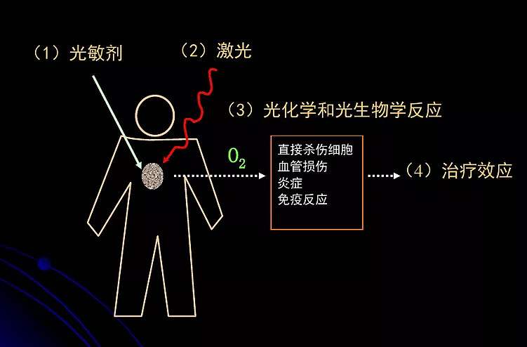 光动力疗法(PDT)，精准地让癌细胞“见光死” 光动力疗法（PDT）是用光敏药物和激光活化治疗肿瘤疾病的一种新方法。用特定波长照射肿瘤部位，能 ...