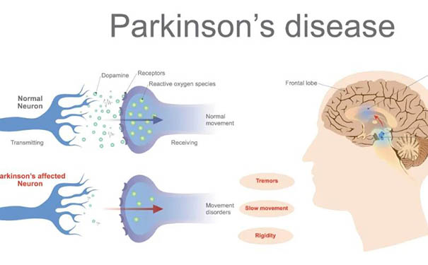 杭州博养医院带您一起走近帕金森综合征-大众康养网