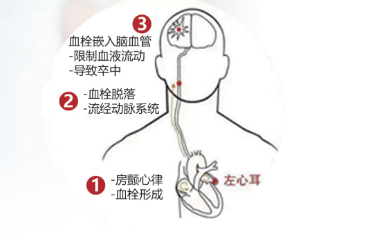 中风是全球重大的公共卫生问题