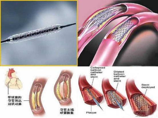 心脏支架