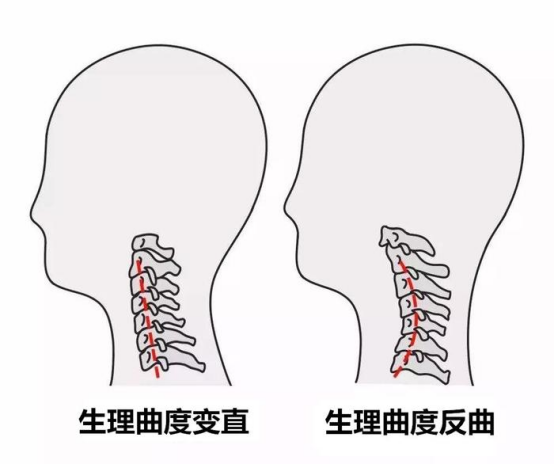 生理曲度和生理曲度反曲对比